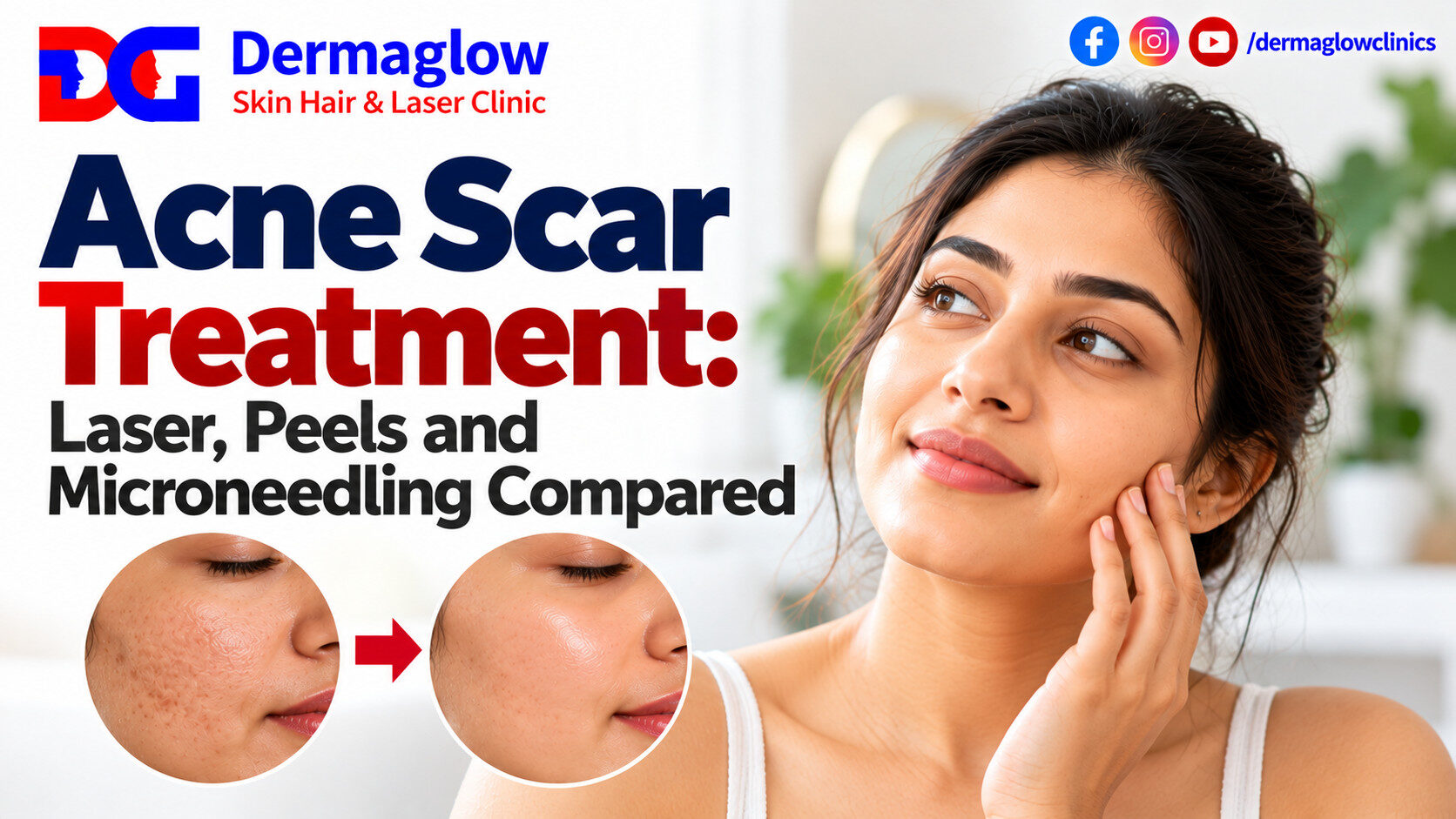 Acne scar treatment by Dermaglow Skin Hair & Laser Clinic, featuring an Indian woman with healthy-looking skin and a before-and-after comparison of acne-scarred skin, highlighting laser treatments, chemical peels, and microneedling.