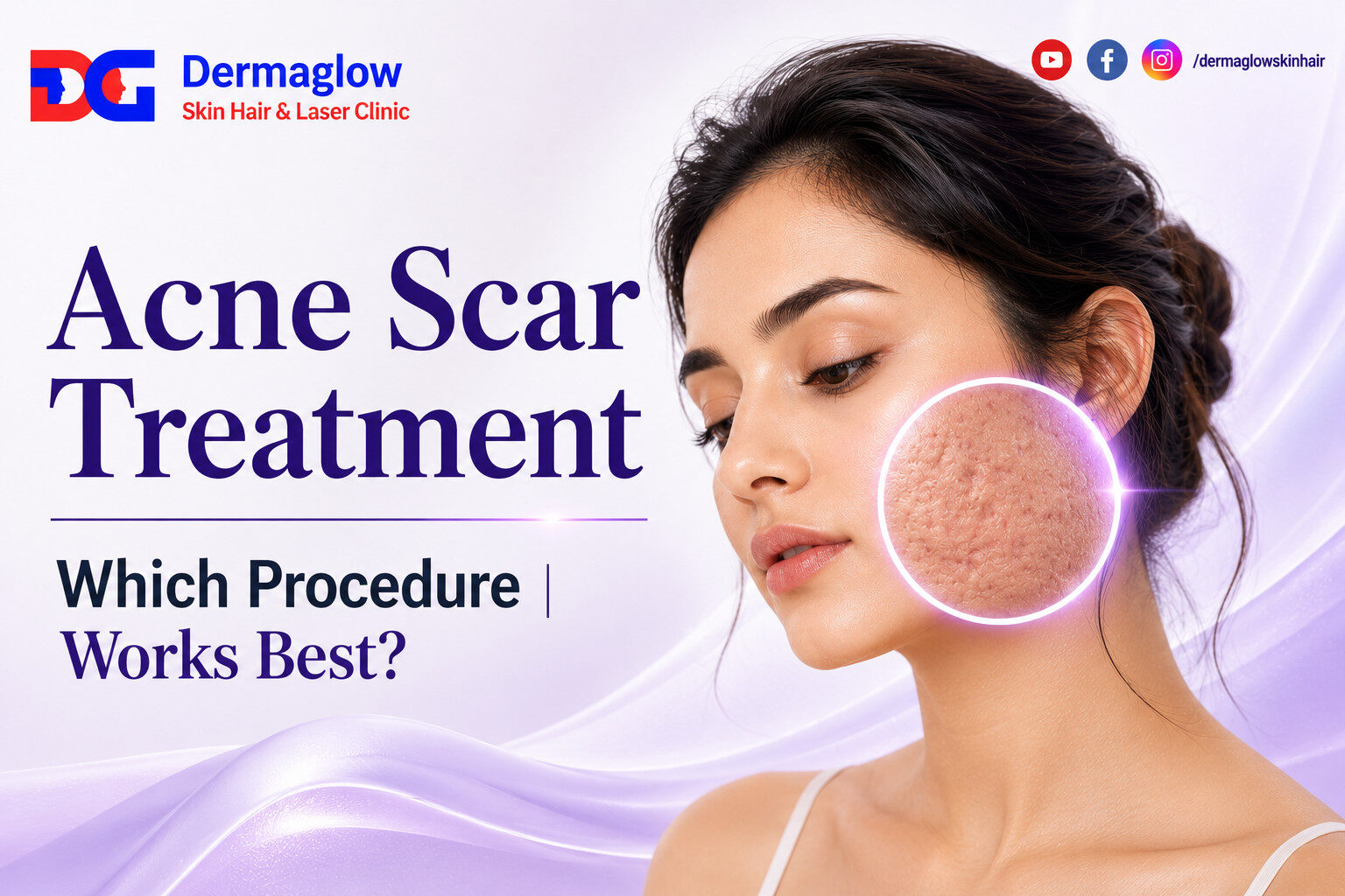 Acne Scar Treatment promotional banner by Dermaglow Skin Hair & Laser Clinic featuring a young woman with clear skin and a highlighted close-up circle showing acne scars on the cheek. The design uses a soft lavender background with the headline “Acne Scar Treatment Which Procedure Works Best?” and clinic branding.
