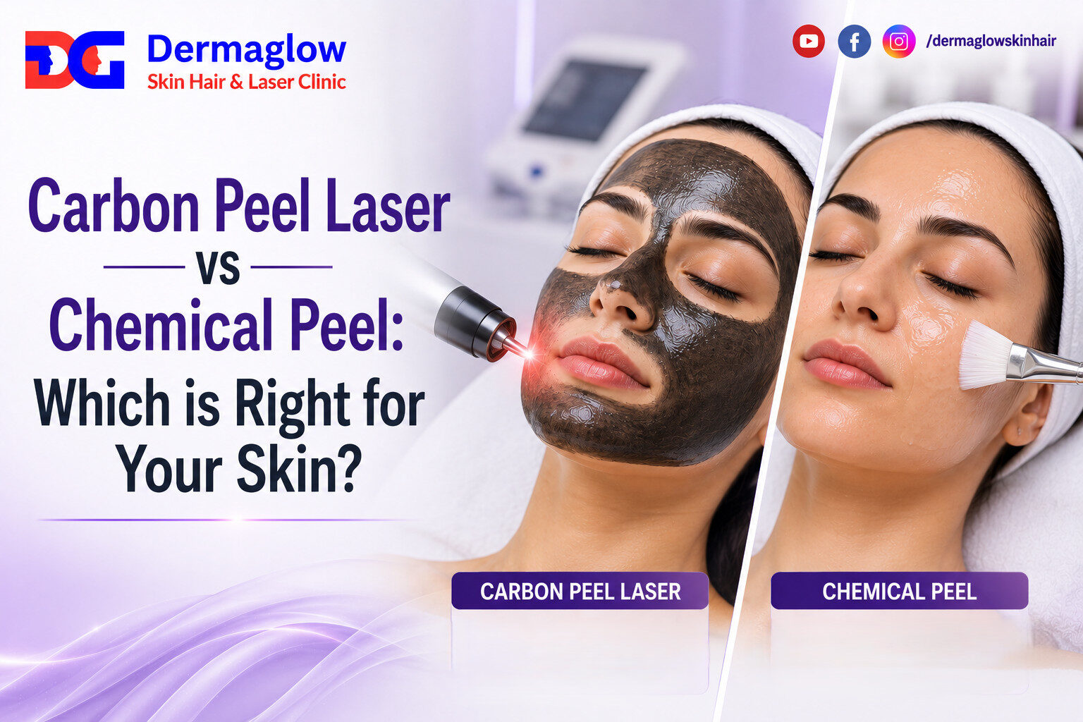 Read more about the article Carbon Peel Laser vs Chemical Peel: Which is Right for Your Skin?