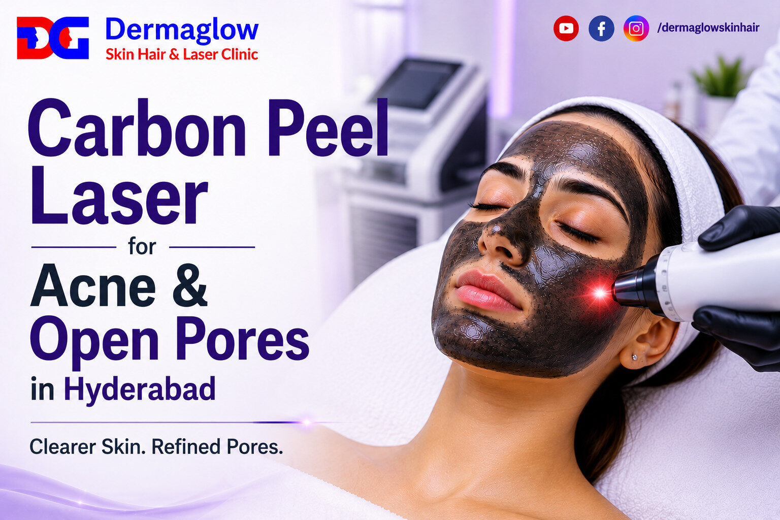 Read more about the article Carbon Peel Laser for Acne & Open Pores in Hyderabad