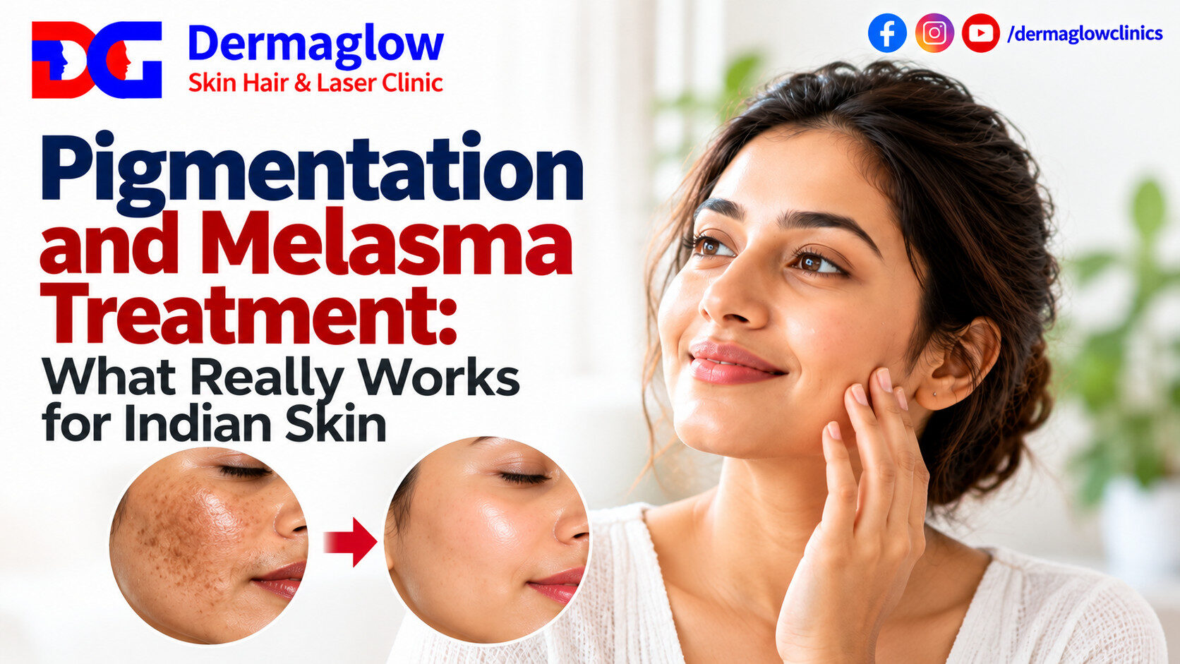 Pigmentation and melasma treatment guide by Dermaglow Skin Hair & Laser Clinic, featuring an Indian woman with healthy-looking skin and a before-and-after comparison illustrating the appearance of facial pigmentation.
