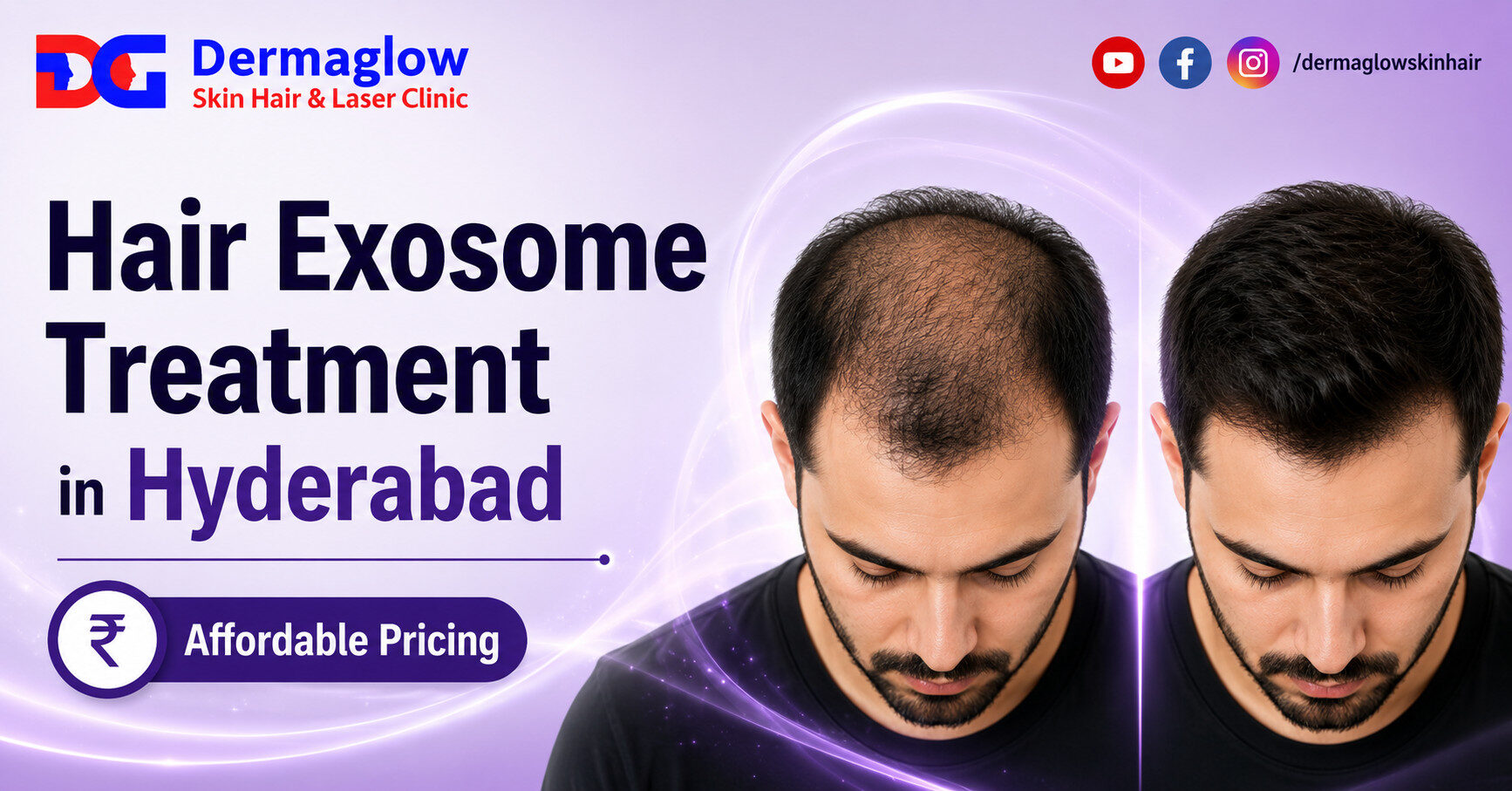 Hair Exosome Treatment in Hyderabad before and after hair restoration result by DermaGlow Skin Hair & Laser Clinic.