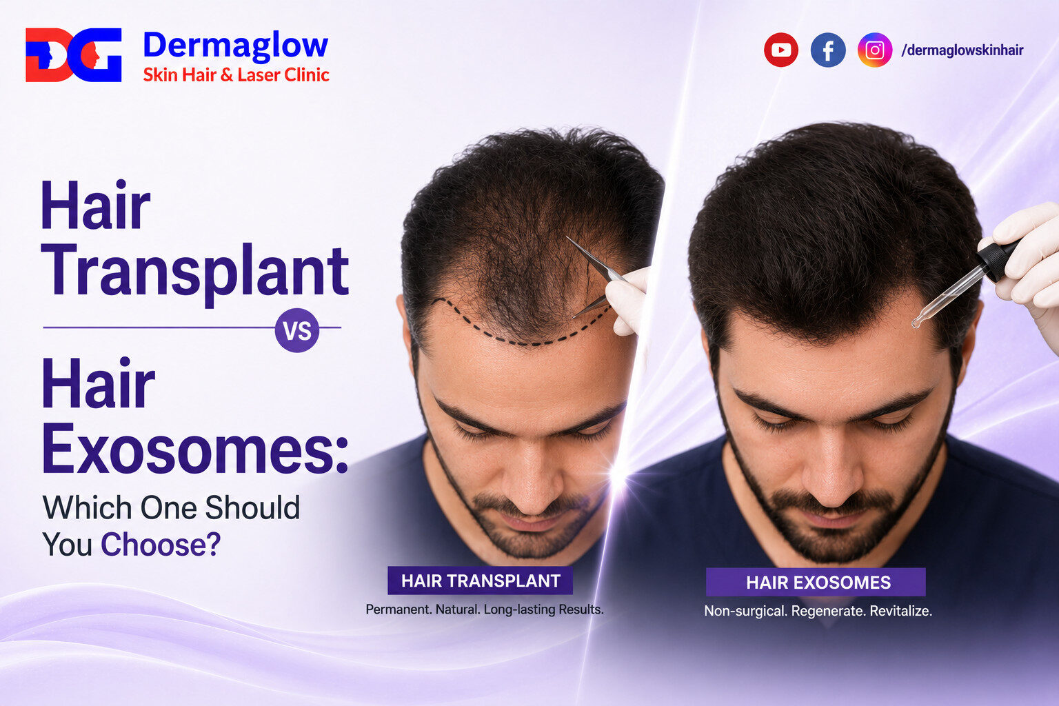 Hair Transplant vs Hair Exosomes comparison banner by Dermaglow Skin Hair & Laser Clinic showing a man with hair thinning on one side and improved hair density on the other side. The graphic compares surgical hair transplant treatment with non-surgical hair exosome therapy.